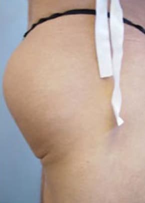 Buttocks Implants Before & After Photos | Associates in Plastic Surgery