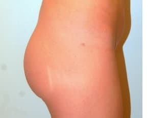 Buttocks Implants Before & After Photos | Associates in Plastic Surgery