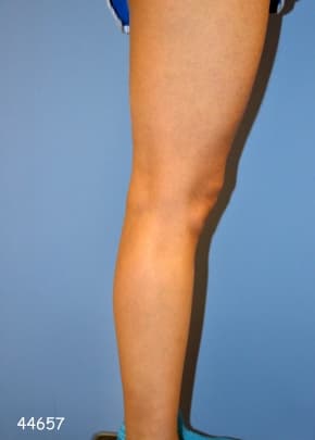 Implants For Bodybuilding Before & After Photos | Associates in Plastic Surgery