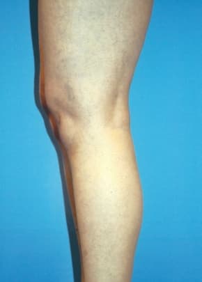 Implants For Bodybuilding Before & After Photos | Associates in Plastic Surgery