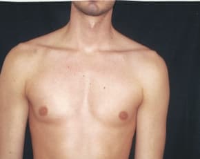 Implants For Bodybuilding Before & After Photos | Associates in Plastic Surgery