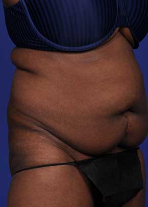 SmarLipo NJ