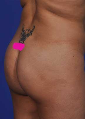 SmarLipo NJ