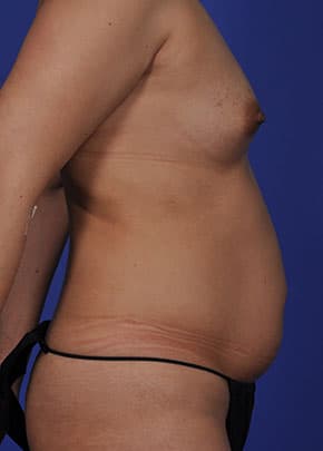 Liposuction And Smartlipo Before & After Photos | Associates in Plastic Surgery