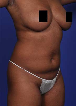 SmarLipo NJ