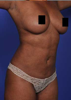 SmarLipo NJ