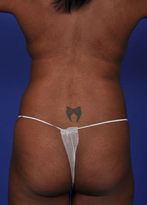 Liposuction And Smartlipo Before & After Photos | Associates in Plastic Surgery