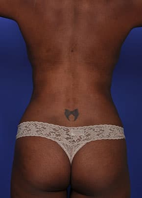 Liposuction And Smartlipo Before & After Photos | Associates in Plastic Surgery