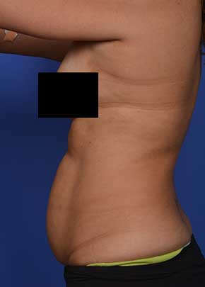 SmarLipo NJ