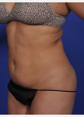 SmarLipo NJ