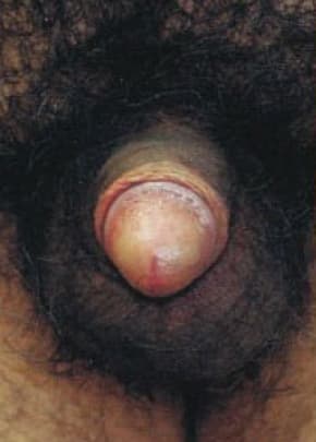 Male Enhancement Before & After Photos | Associates in Plastic Surgery