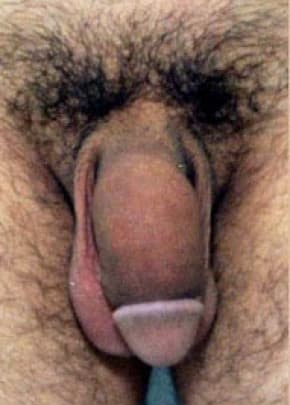 Male Enhancement Before & After Photos | Associates in Plastic Surgery