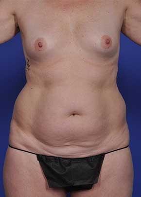 Mommy Makeover Before & After Photos | Associates in Plastic Surgery
