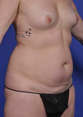 Mommy Makeover Before & After Photos | Associates in Plastic Surgery