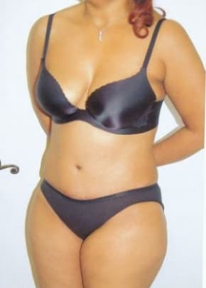 Tummy Tuck Before & After Photos | Associates in Plastic Surgery