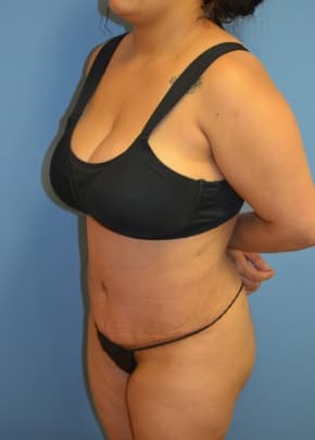 Tummy Tuck Before & After Photos | Associates in Plastic Surgery