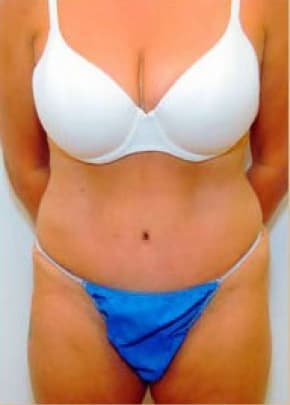 Tummy Tuck Before & After Photos | Associates in Plastic Surgery