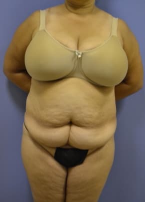 Tummy Tuck Before & After Photos | Associates in Plastic Surgery