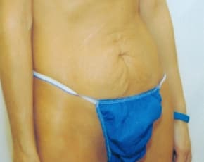 Tummy Tuck Before & After Photos | Associates in Plastic Surgery