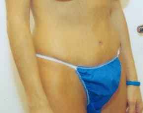 Tummy Tuck Before & After Photos | Associates in Plastic Surgery