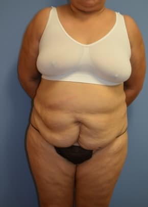 Tummy Tuck Before & After Photos | Associates in Plastic Surgery
