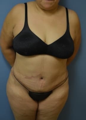 Tummy Tuck Before & After Photos | Associates in Plastic Surgery