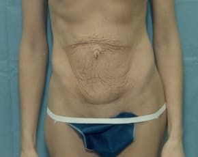 Tummy Tuck Before & After Photos | Associates in Plastic Surgery