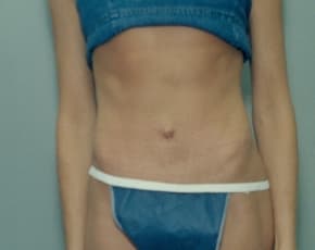 Tummy Tuck Before & After Photos | Associates in Plastic Surgery
