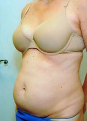 Tummy Tuck Before & After Photos | Associates in Plastic Surgery