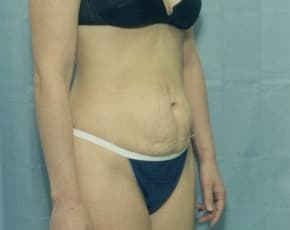 Tummy Tuck Before & After Photos | Associates in Plastic Surgery