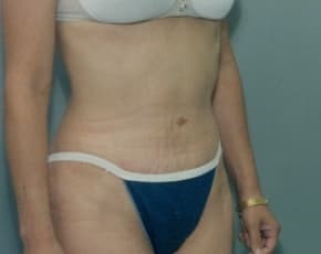 Tummy Tuck Before & After Photos | Associates in Plastic Surgery