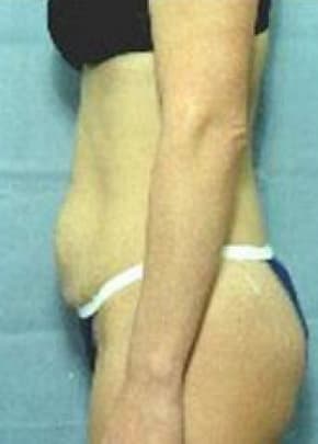 Tummy Tuck Before & After Photos | Associates in Plastic Surgery