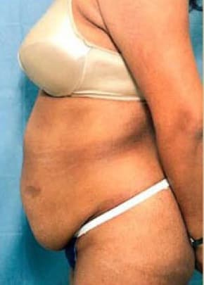 Tummy Tuck Before & After Photos | Associates in Plastic Surgery