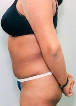 Tummy Tuck Before & After Photos | Associates in Plastic Surgery