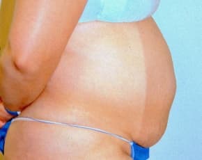 Tummy Tuck Before & After Photos | Associates in Plastic Surgery