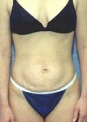 Tummy Tuck Before & After Photos | Associates in Plastic Surgery