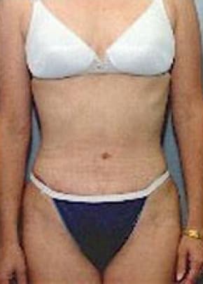 Tummy Tuck Before & After Photos | Associates in Plastic Surgery