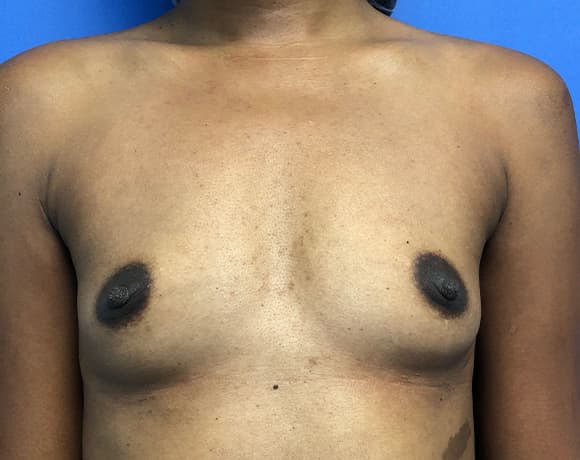 Breast Augmentation Before & After Photos | Associates in Plastic Surgery