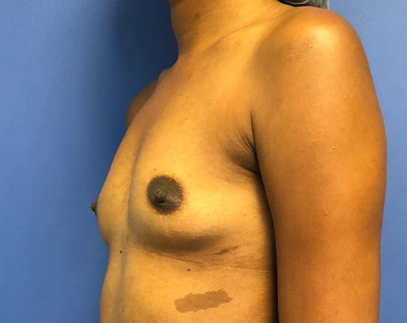 Breast Augmentation Before & After Photos | Associates in Plastic Surgery