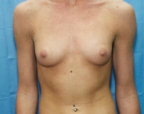 Breast Augmentation Before & After Photos | Associates in Plastic Surgery