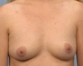 Breast Augmentation Before & After Photos | Associates in Plastic Surgery