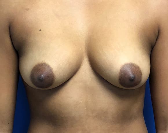 Breast Augmentation Before & After Photos | Associates in Plastic Surgery