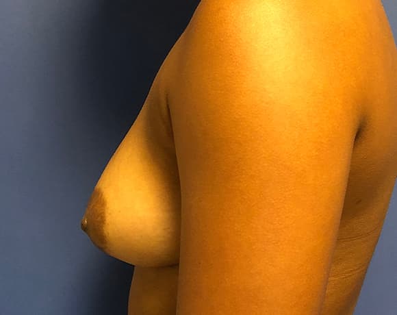 Breast Augmentation Before & After Photos | Associates in Plastic Surgery