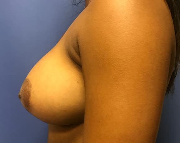 Breast Augmentation Before & After Photos | Associates in Plastic Surgery