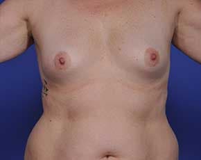 Breast Augmentation Before & After Photos | Associates in Plastic Surgery