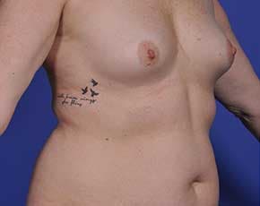 Breast Augmentation Before & After Photos | Associates in Plastic Surgery