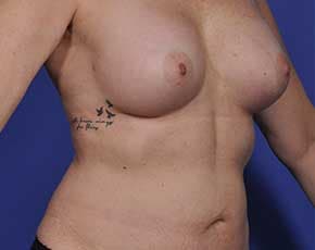 Breast Augmentation Before & After Photos | Associates in Plastic Surgery