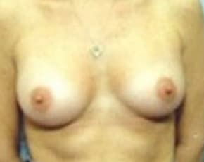 Breast Augmentation Before & After Photos | Associates in Plastic Surgery