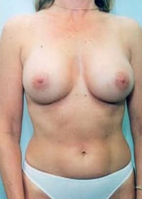 Breast Augmentation Before & After Photos | Associates in Plastic Surgery