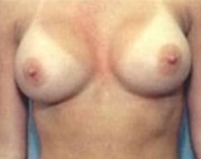 Breast Augmentation Before & After Photos | Associates in Plastic Surgery